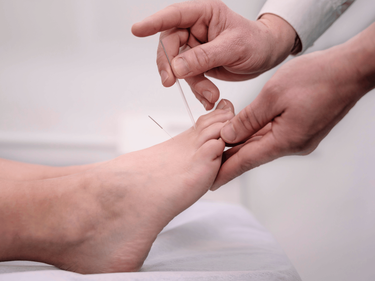 Acupuncture for ChemotherapyInduced Peripheral Neuropathy Journal of